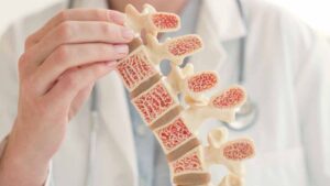 osteoporosis