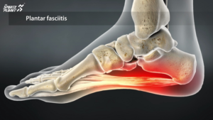 Plantar Fasciitis