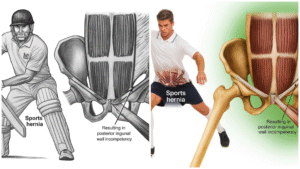 Decoding Sports Hernia: Why Suryakumar Yadav's Injury Is A Crucial Conversation For Athletes